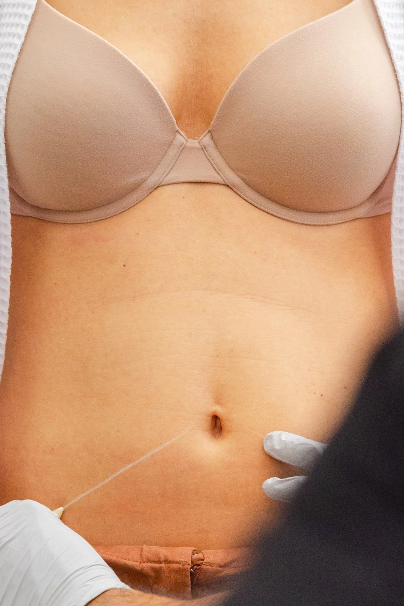 Salas Plastic Surgery - Tummy Tuck-1884.jpg