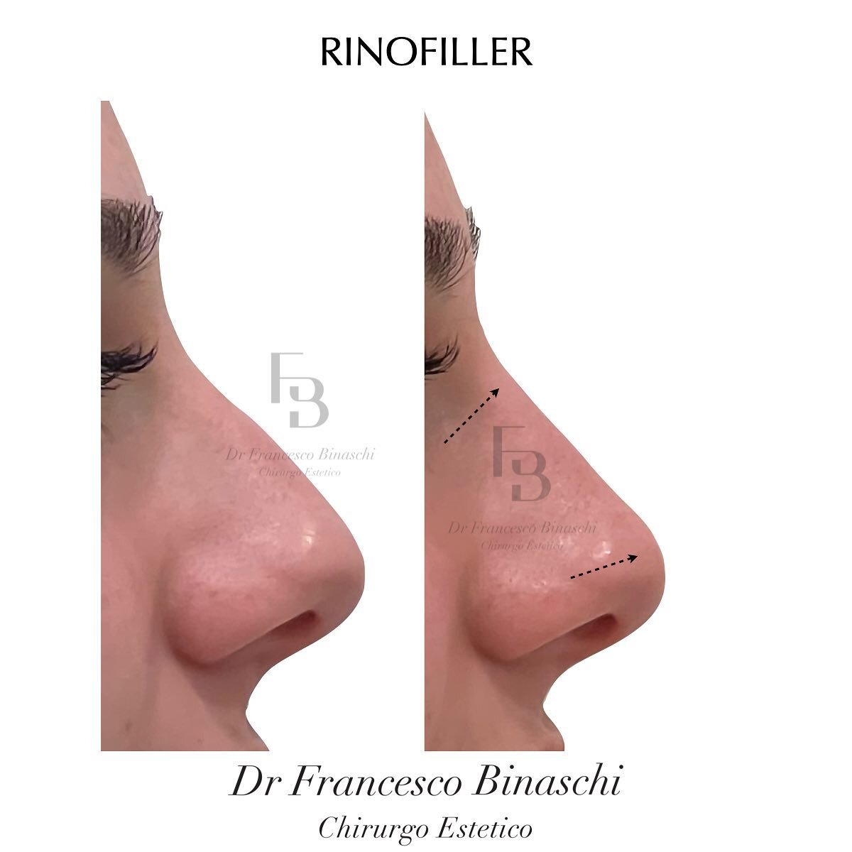 RINOFILLER - PRIMA/DOPO

🔎 Il naso della paziente nell&rsquo;immagine a sinistra presenta una curva, un inestetismo che pu&ograve; non piacere sul proprio viso. 

🎯 Alla destra si ha un naso molto pi&ugrave; lineare, senza sporgenze. 

🌟 Grazie al