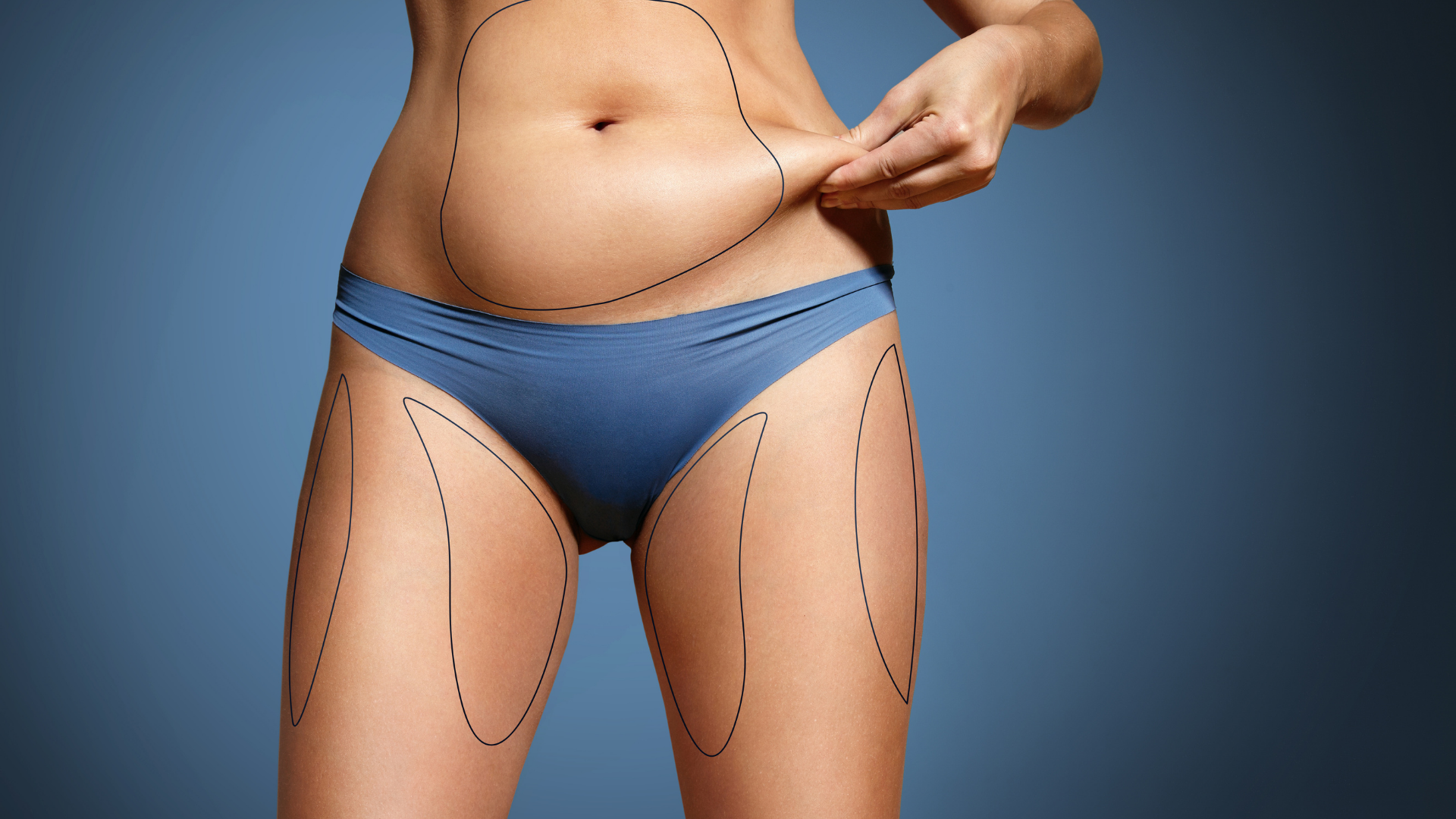 Liposucción Dr. Mauro Vázquez Armenta