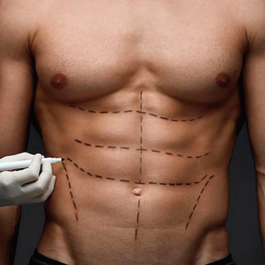 portada-abdominoplastia-hombre.jpg