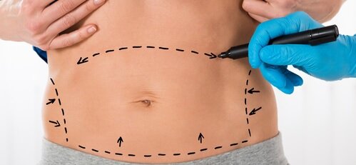 abdominoplastia-2_1.jpg