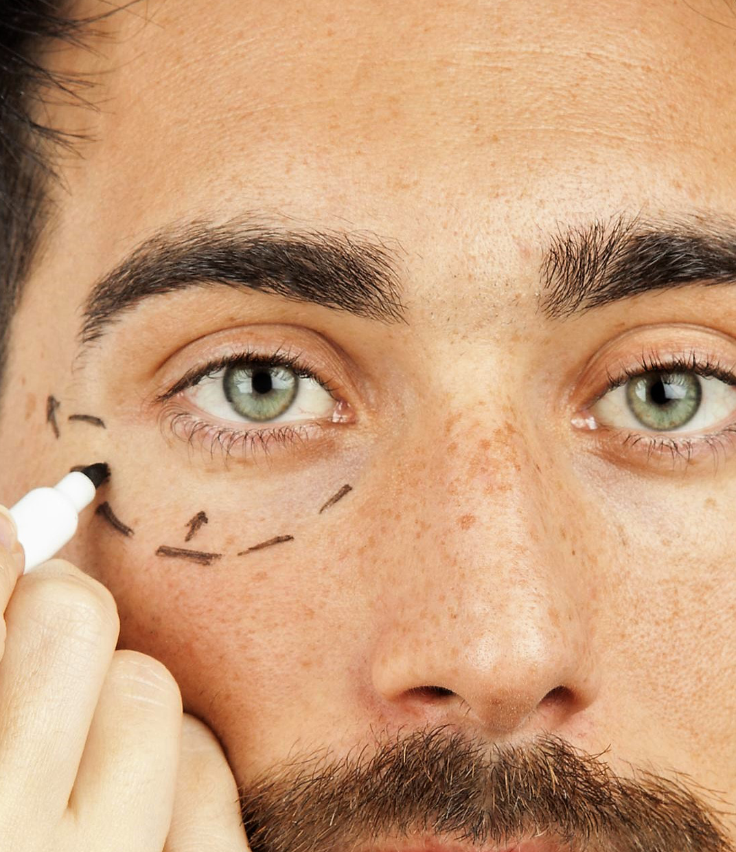 Blefaroplastia.png