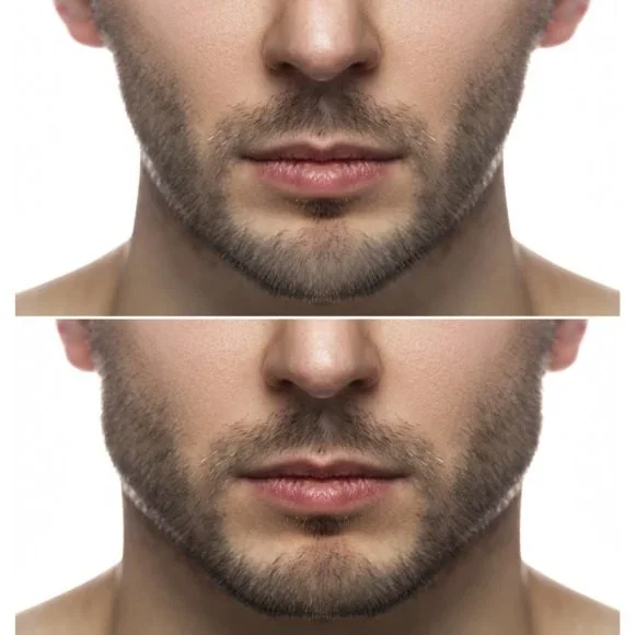 Comparison of two close-up photos of a man's face, focusing on facial hair and skin texture.