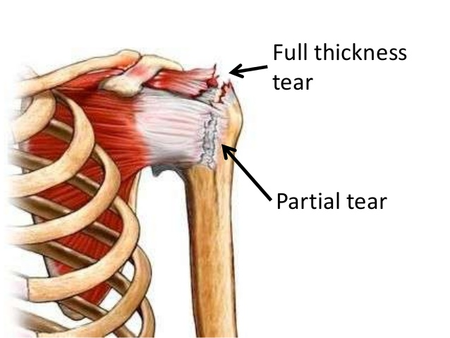 Partial Rotator Cuff Tear Symptoms – STHM