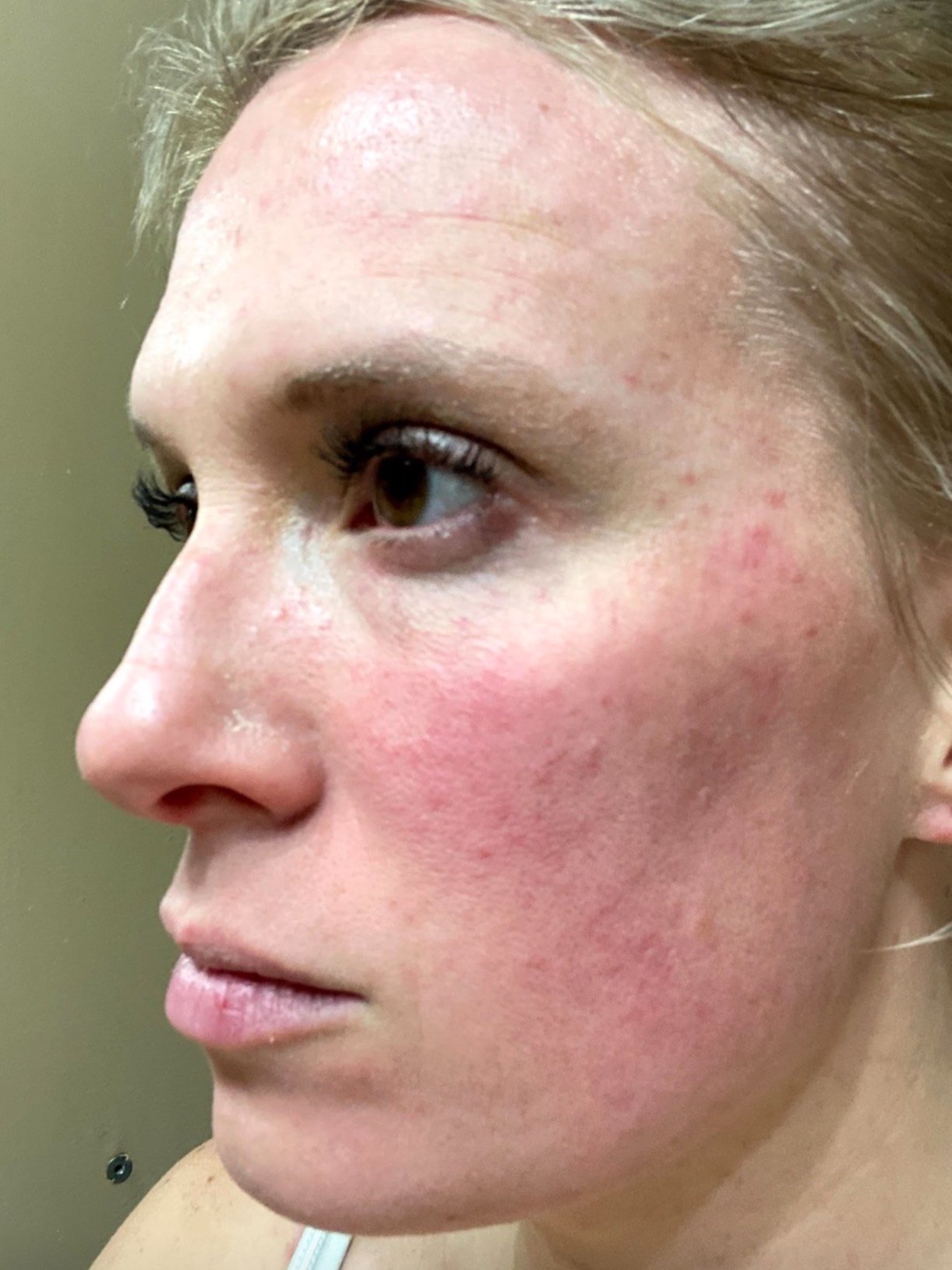 5 Must-Have Products for Rosacea: My Rosacea Experience — Meredith Hudkins