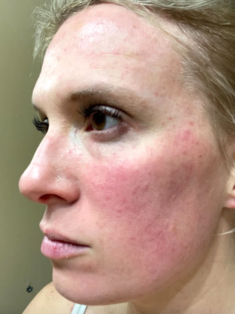 5 MustHave Products for Rosacea My Rosacea Experience — Meredith Hudkins