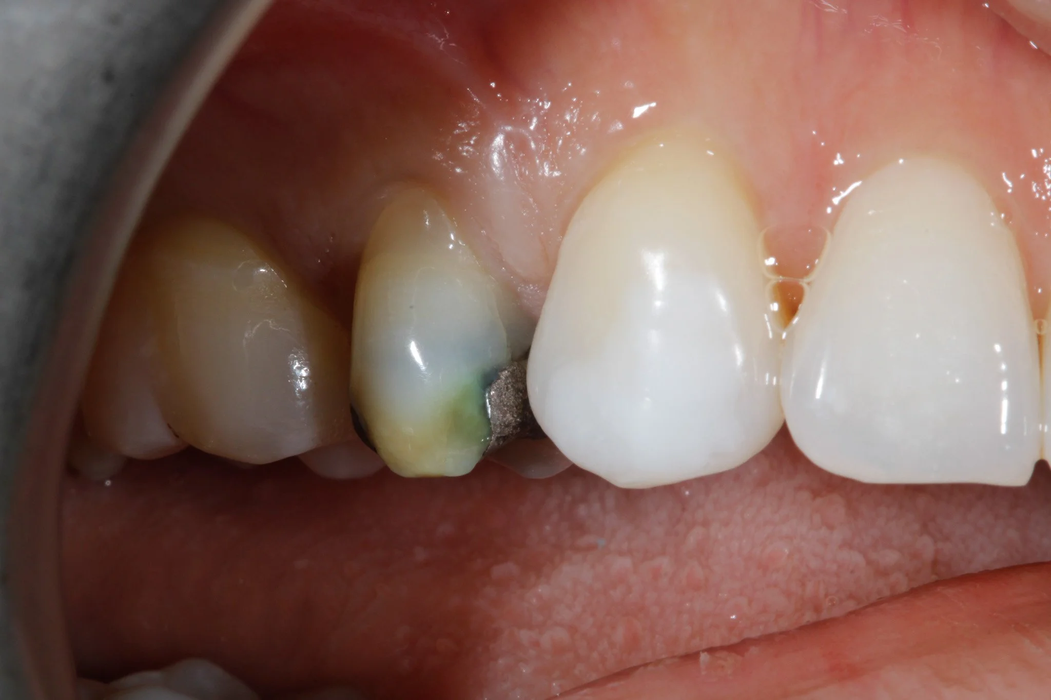 Overhanging Fillings Explained -  The Hidden Cause of Bleeding Gums