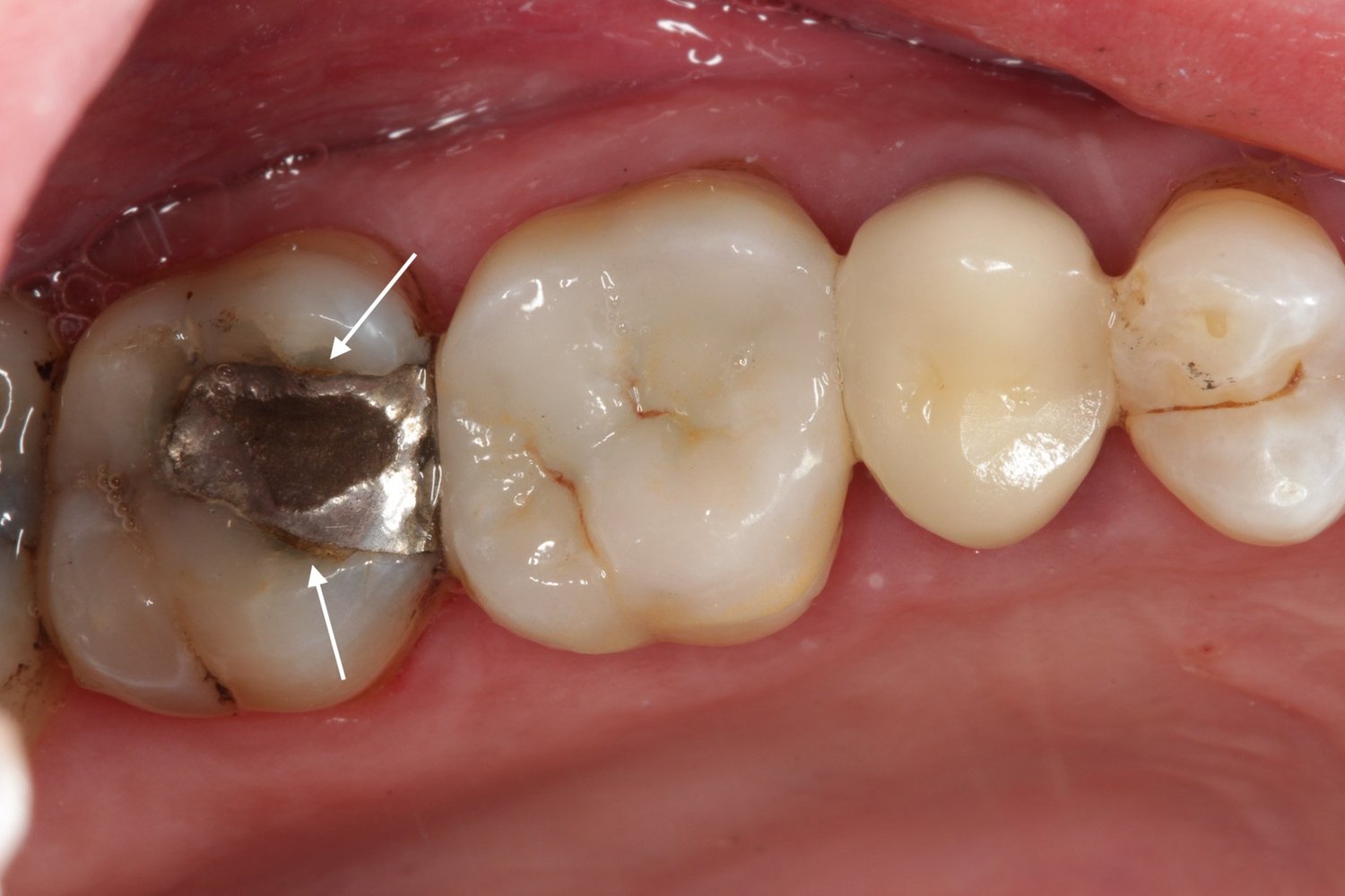 Broken Filling: Do You Need to Replace It? — Nova Smiles