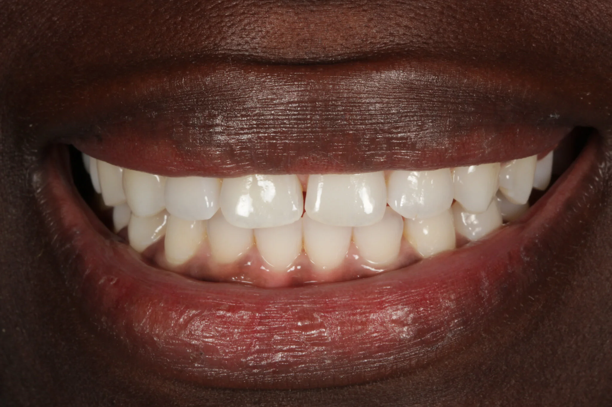 Composite Bonding | Enhance Your Smile Today — Nova Smiles