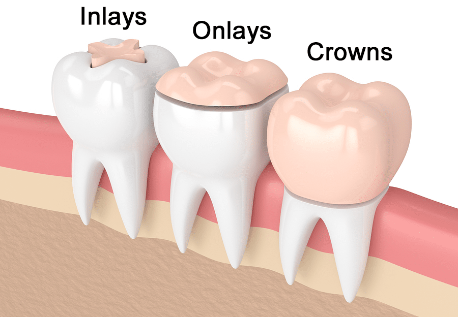 Crowns Vs Onlays Which One Is Right For You The Online Dentist Crowns Vs Onlays Which One Is Right For You The Online Dentist