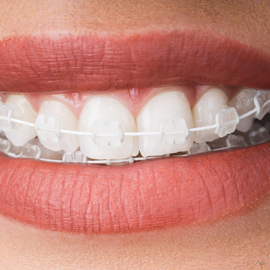 Do Braces Change Your Mouth Shape?