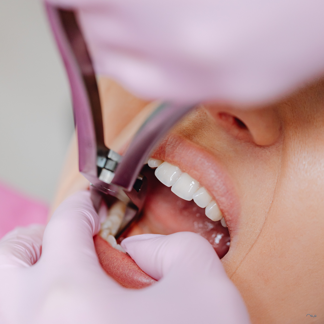A Tooth Is More Than a Tooth: What Really Happens After an Extraction