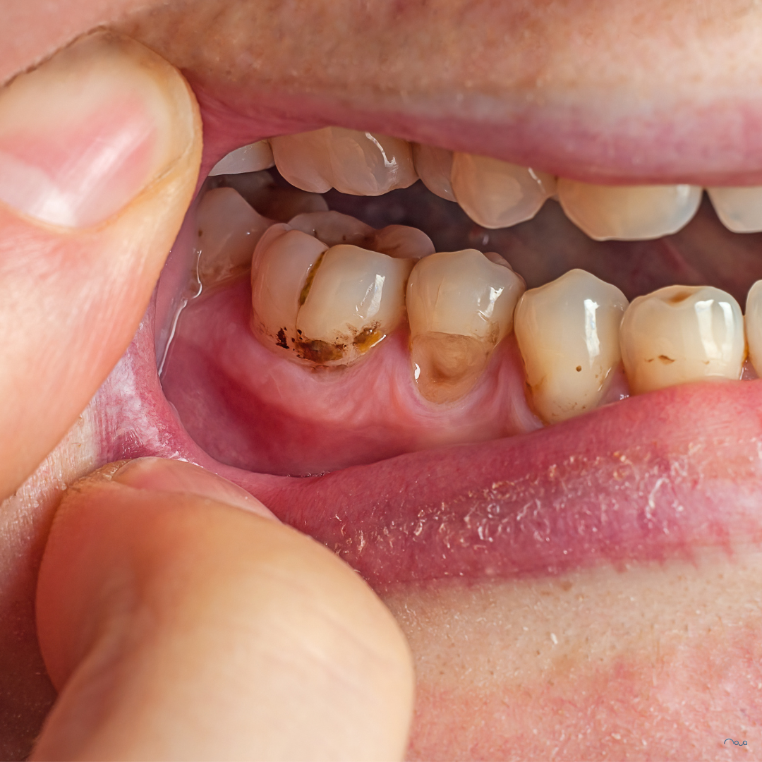 5 Signs Your Teeth Might Not Be as Healthy as You Think