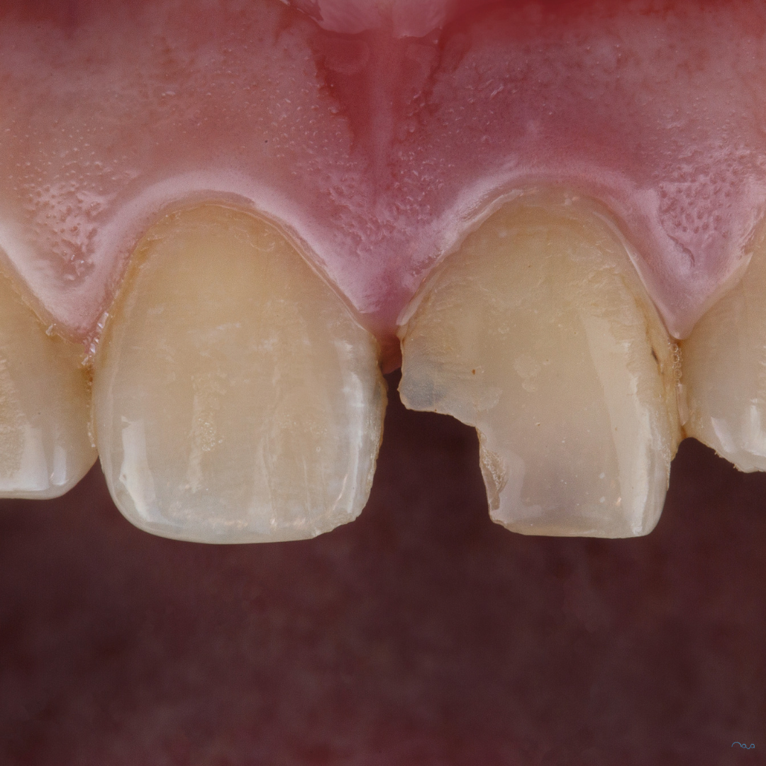 Broken, Chipped or Cracked Tooth: What to Do