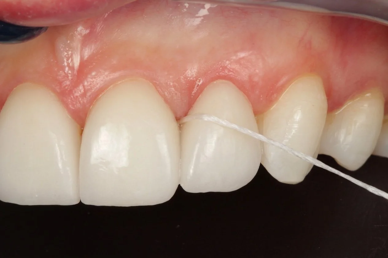 How to look after your veneers