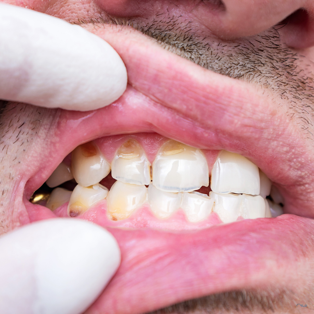 Why Do My Teeth Feel Rough Even After Brushing?