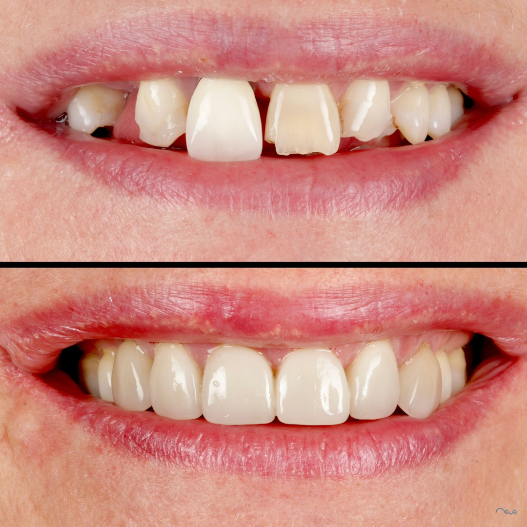 The Everyday Habits That Are Wearing Down Your Teeth