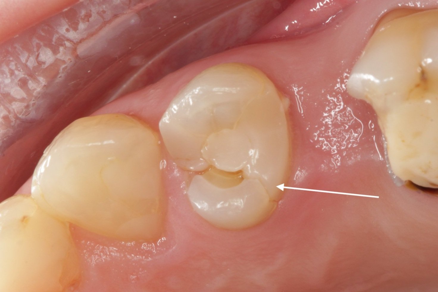 Root Canal Crown root-canal-crown