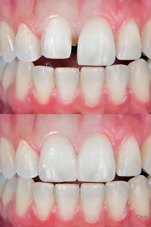 A guide to how long veneers last by an experienced dentist — Nova Smiles