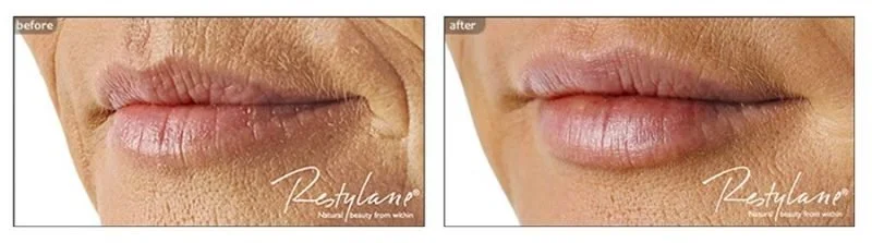 How to get rid of lip lines?