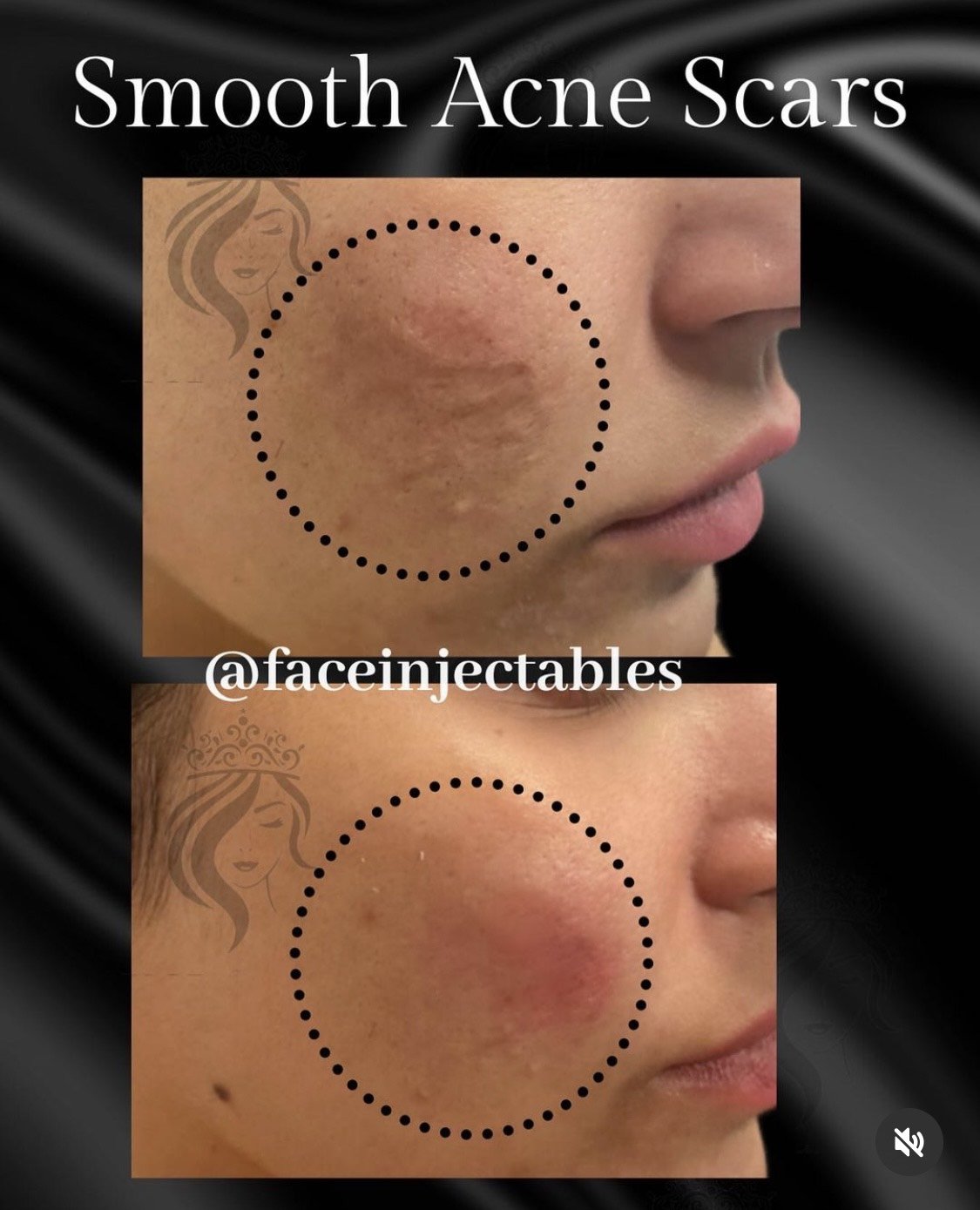 acne scars fillers before and after.jpeg