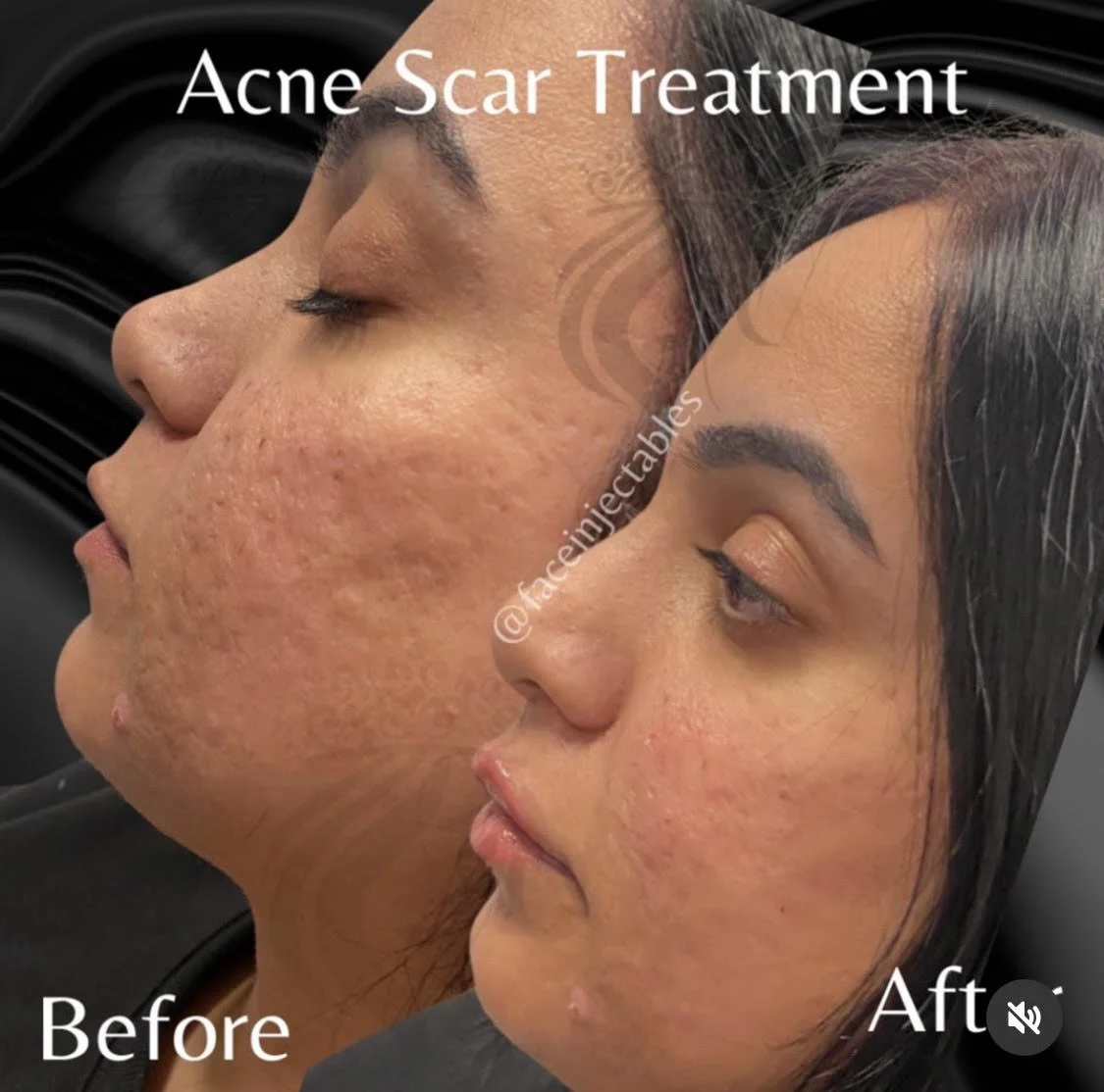 Acne scar filler results.jpg