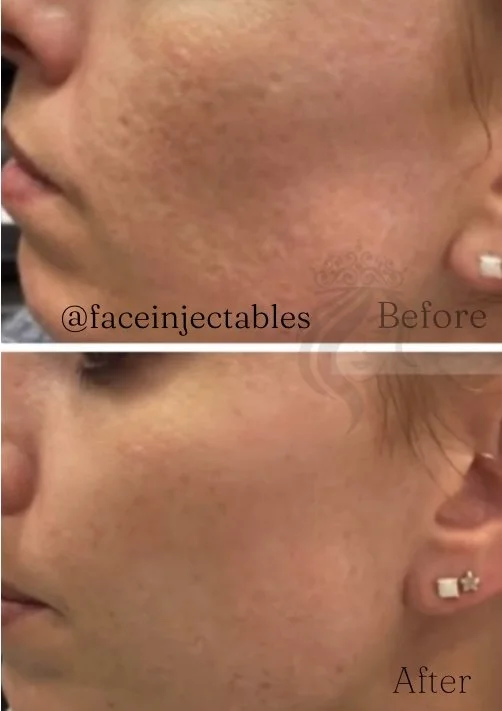 Acne Scar Treatments — FACE Injectables