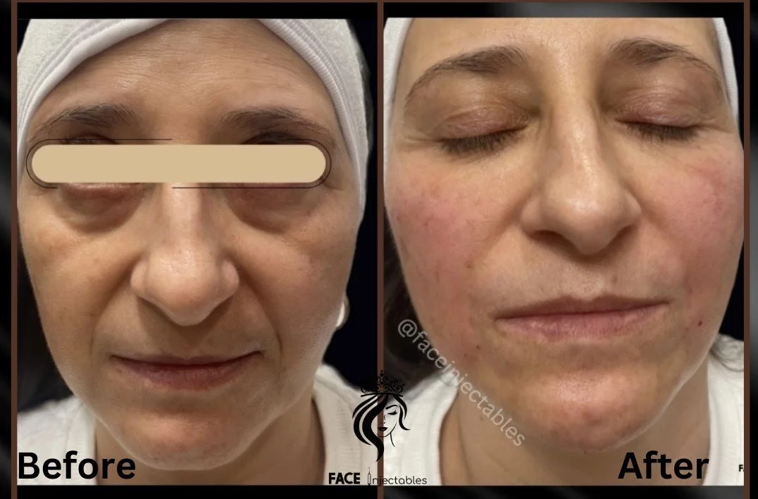 Non-surgical-facelift-toronto