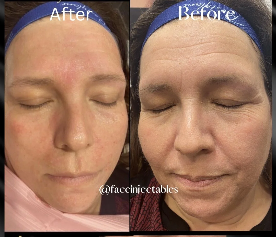 Aquagold facial vaughan ontario.jpg