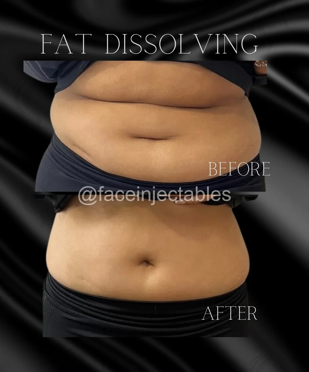 belly-fat-dissolving-before-after-vaughan-face-injectables.jpg