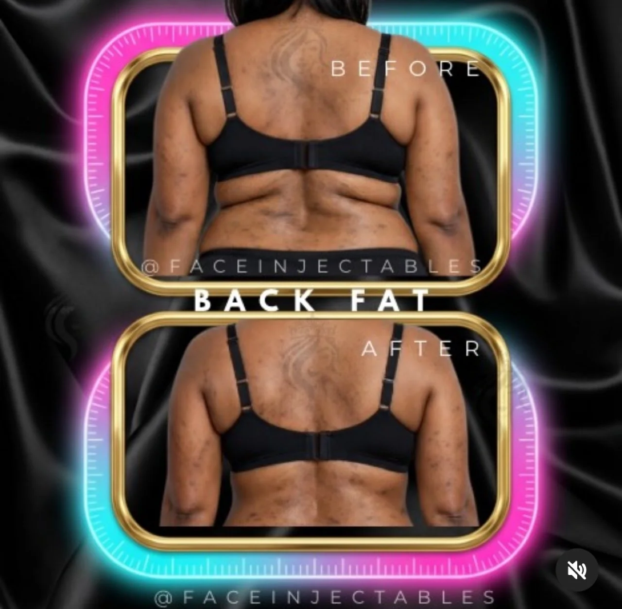 Back rolls fat dissolving injections before and after results for Toronto clients at Face Injectable