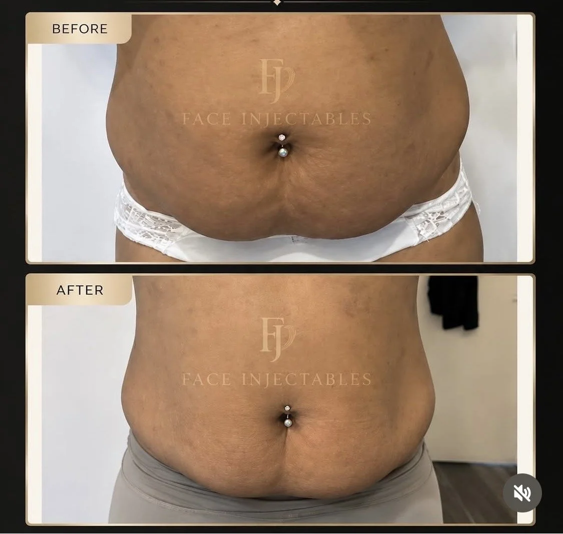 Before and after stomach fat dissolving of the lower abdomen in Vaughan