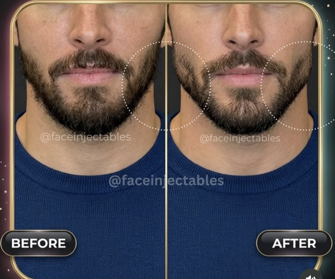 Male jawline and chin filler before and after in Vaughan showing natural-looking lower-face definition at Face Injectables.
