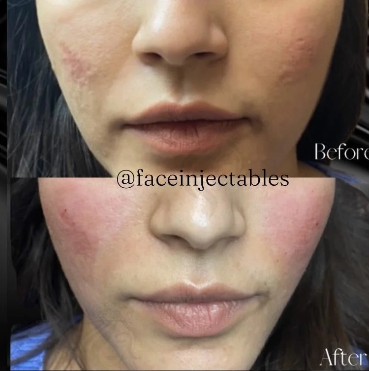 Acne Scar Treatments — FACE Injectables