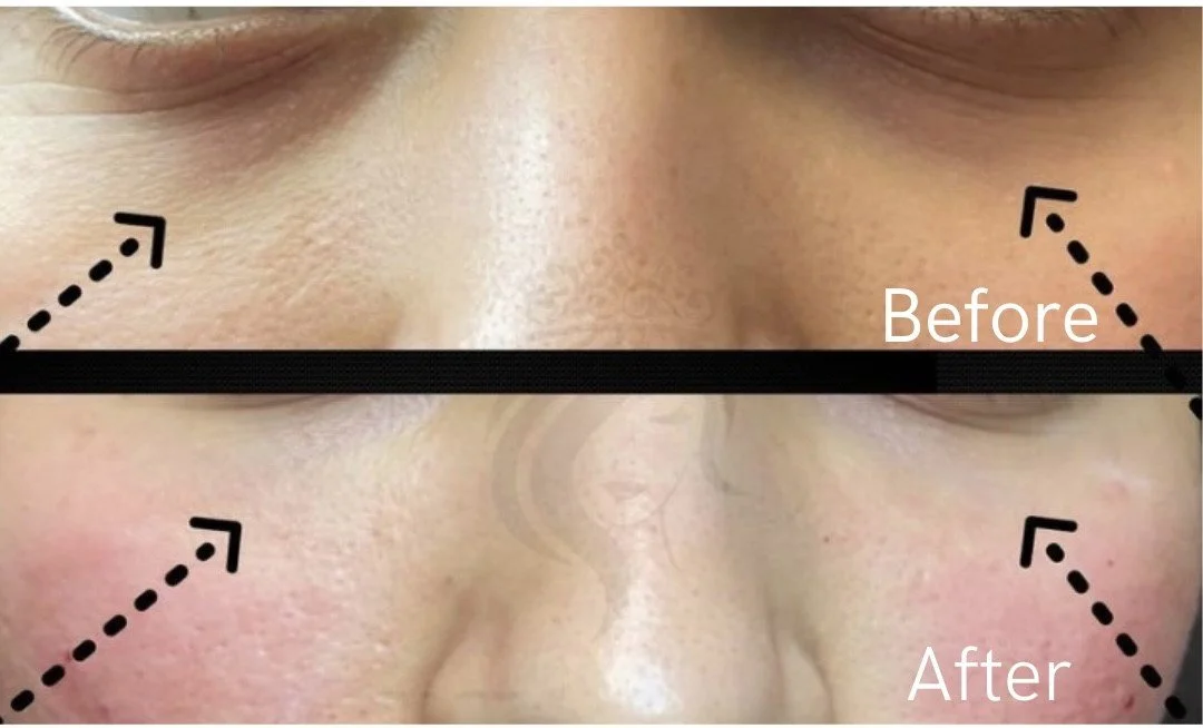 tear trough filler before and after pictures.jpg