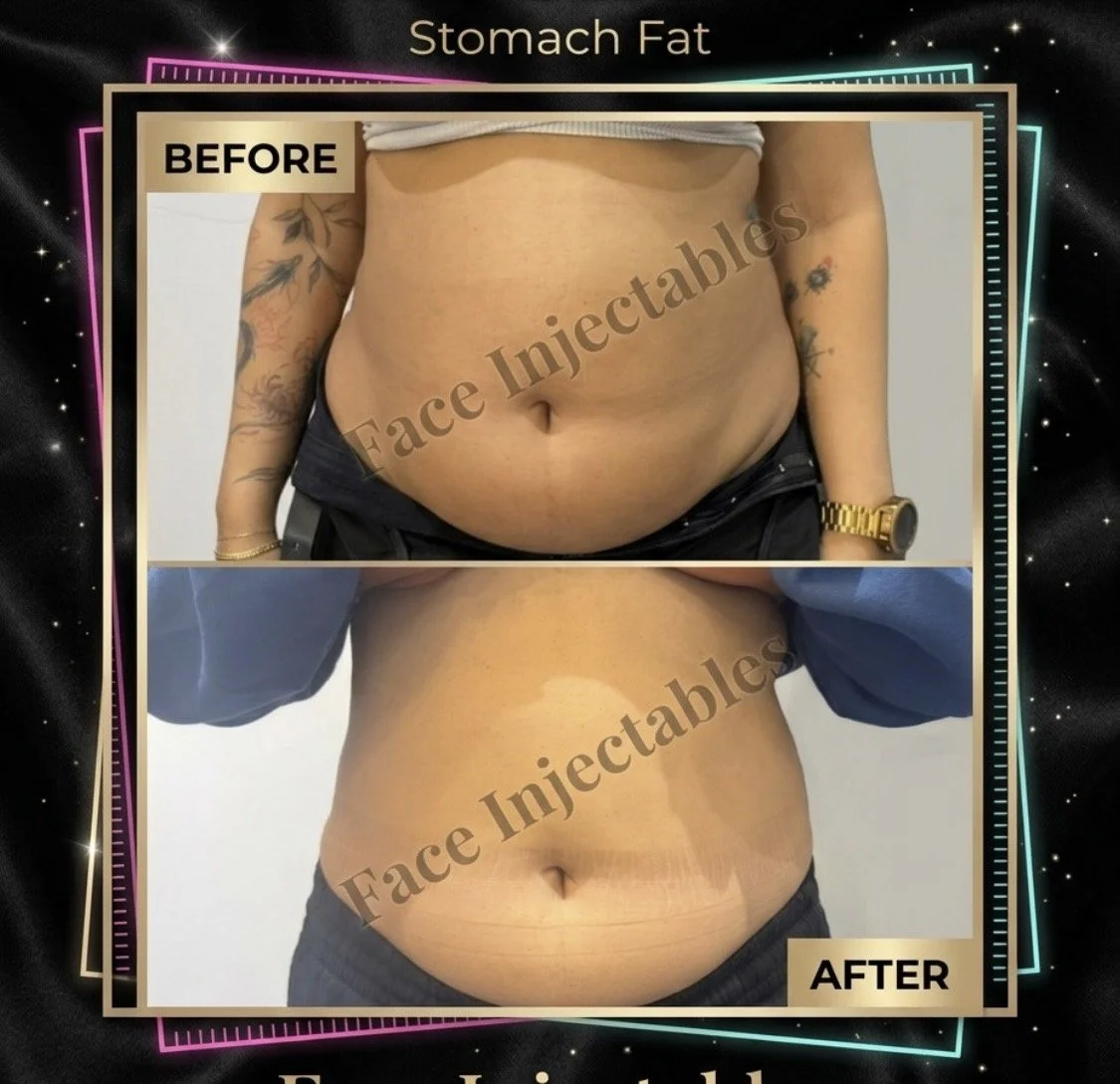 Before and after stomach fat dissolving of the upper abdomen in Vaughan
