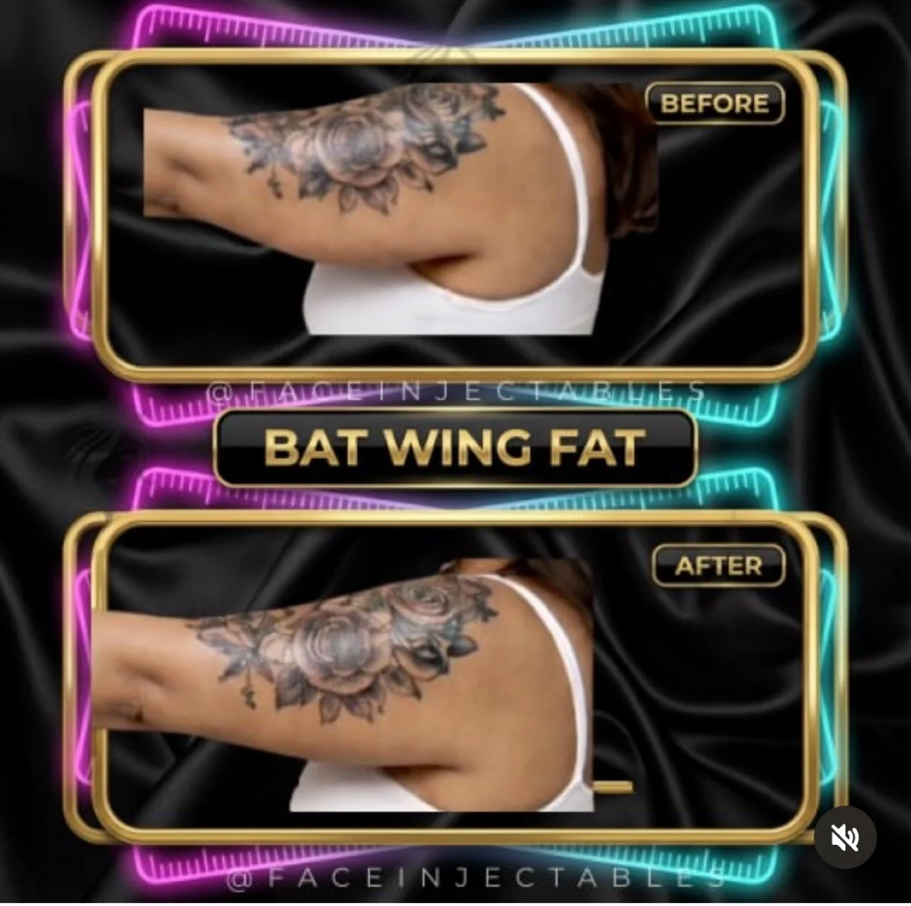 “Upper arm contouring results after a treatment plan. Results vary.”