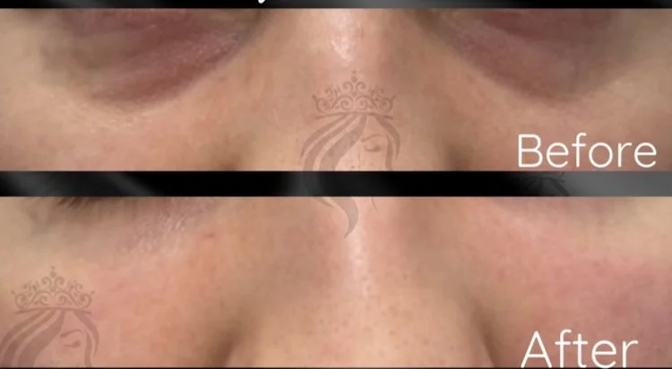dark under eye circles removal.jpg