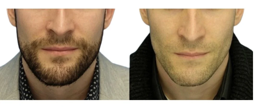Beards | Enhance Your Beard — FACE Injectables