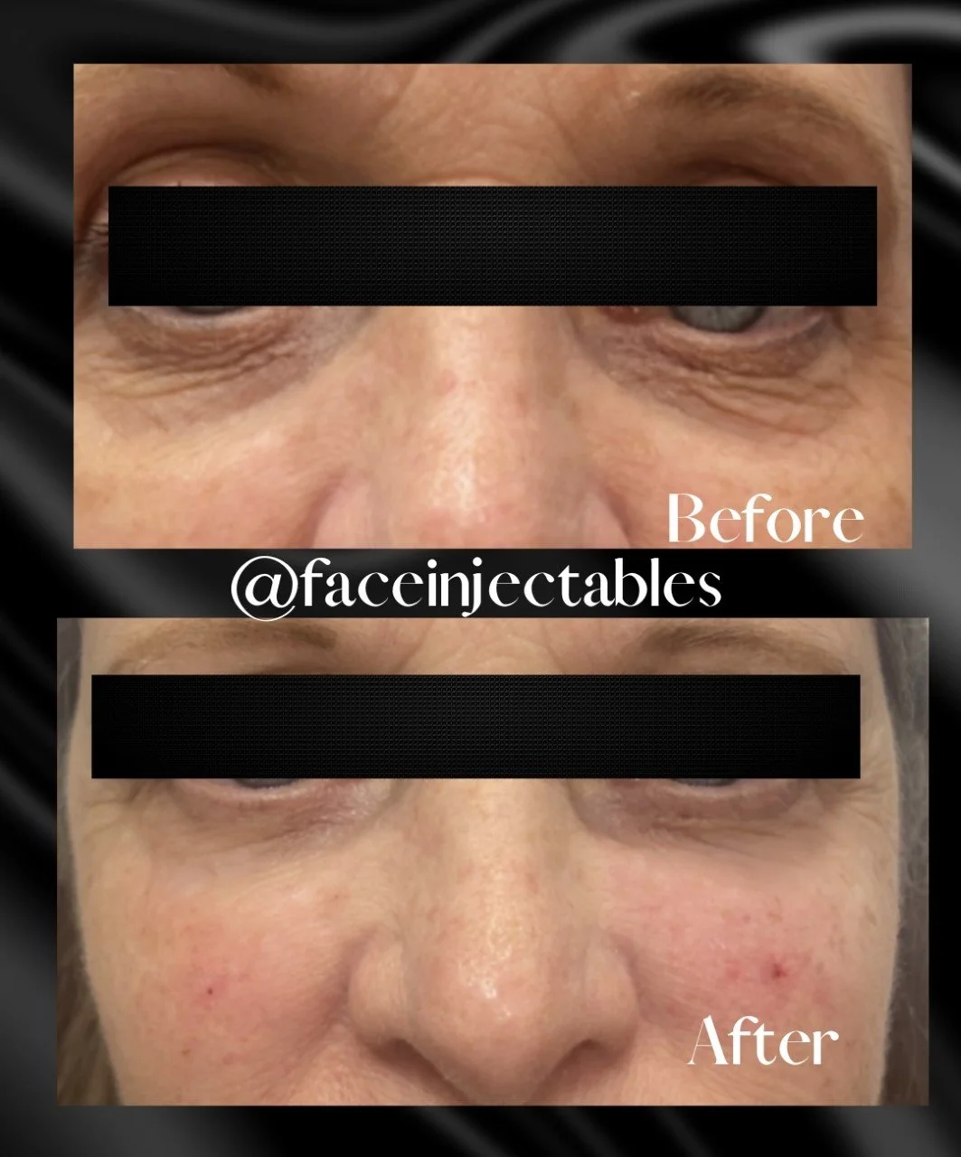 dark under eye circle treatment vaughan ontario.jpg