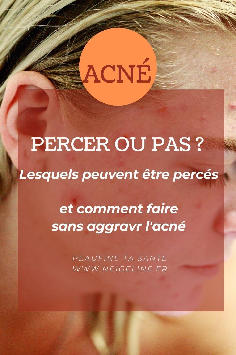 Bouton d'acné : percer ou pas ? — Neigeline, experte Acné