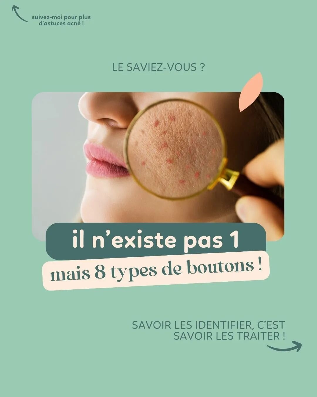 L&rsquo;acn&eacute;, c&rsquo;est avoir des boutons. Certes, mais saviez-vous qu&rsquo;il existe plusieurs types de boutons ?

*boutons r&eacute;tentionnels : com&eacute;dons ferm&eacute;s com&eacute;don ouverts (point blancs ou noirs), microkystes

*