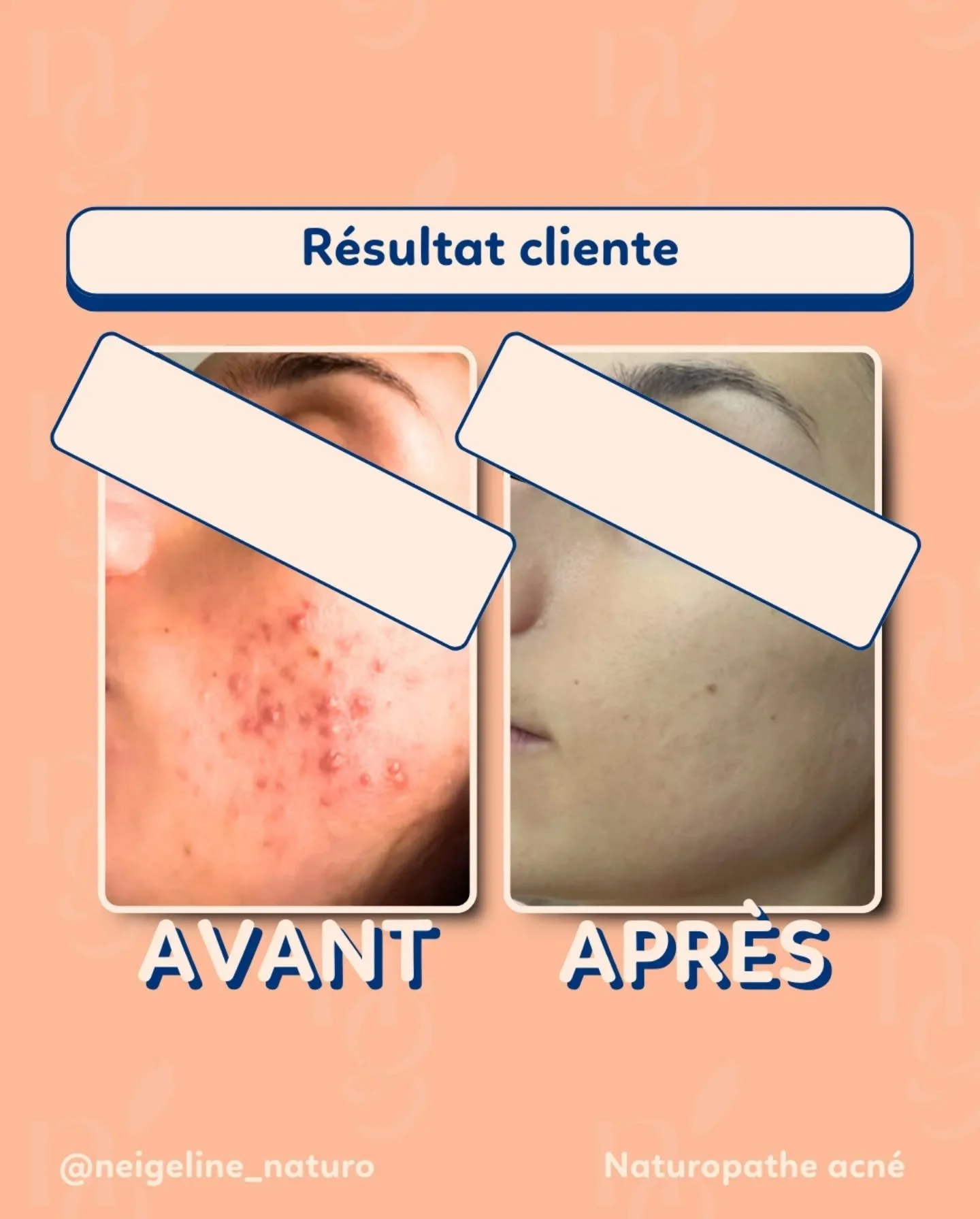 Code : ACNE50
&ldquo;Grace aux changements d&rsquo;habitude propos&eacute; par Neigeline, et une cure qui m&rsquo;a fait beaucoup de bien, le r&eacute;sultat est finalement l&agrave; : une belle peau &eacute;clatante ! Sans Neigeline, il est tr&egrav
