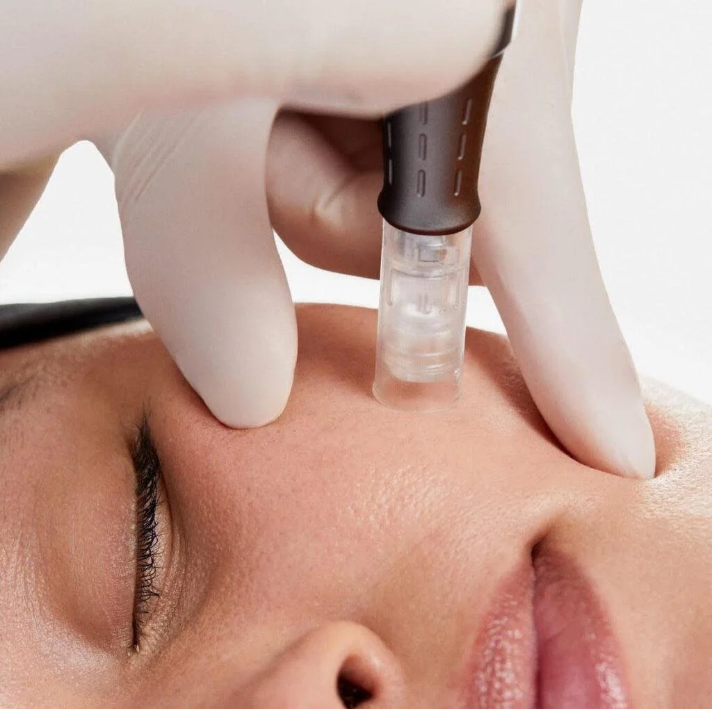 A person receiving a cosmetic or medical treatment with a hypodermic needle, administered by a gloved hand.