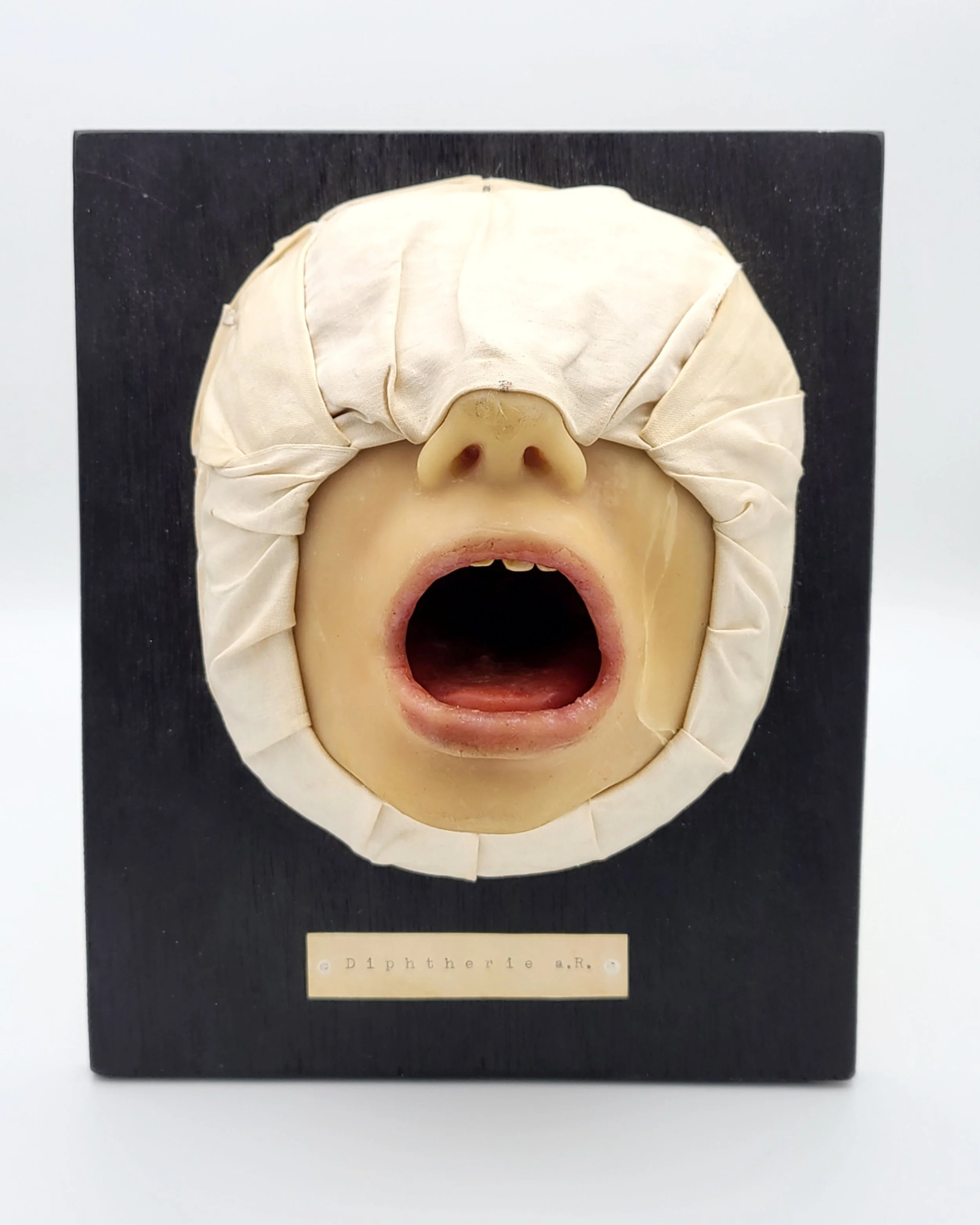 Wax moulage showing Diptheria