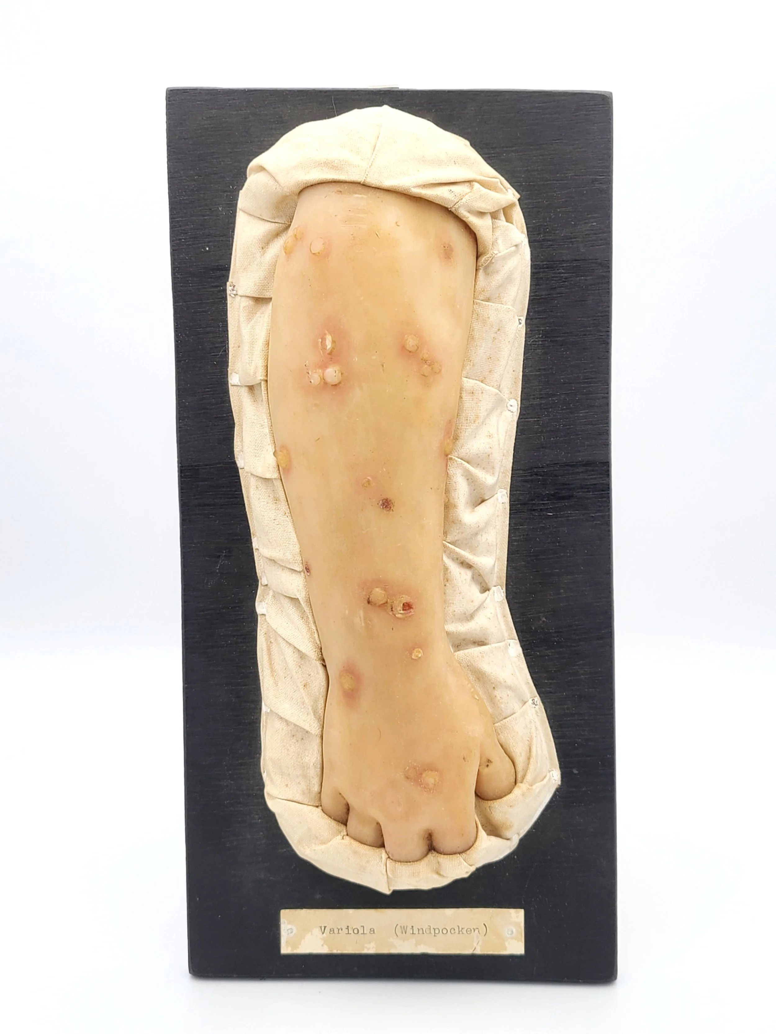 Wax moulage of a child's arm showing Smallpox or Chickenpox