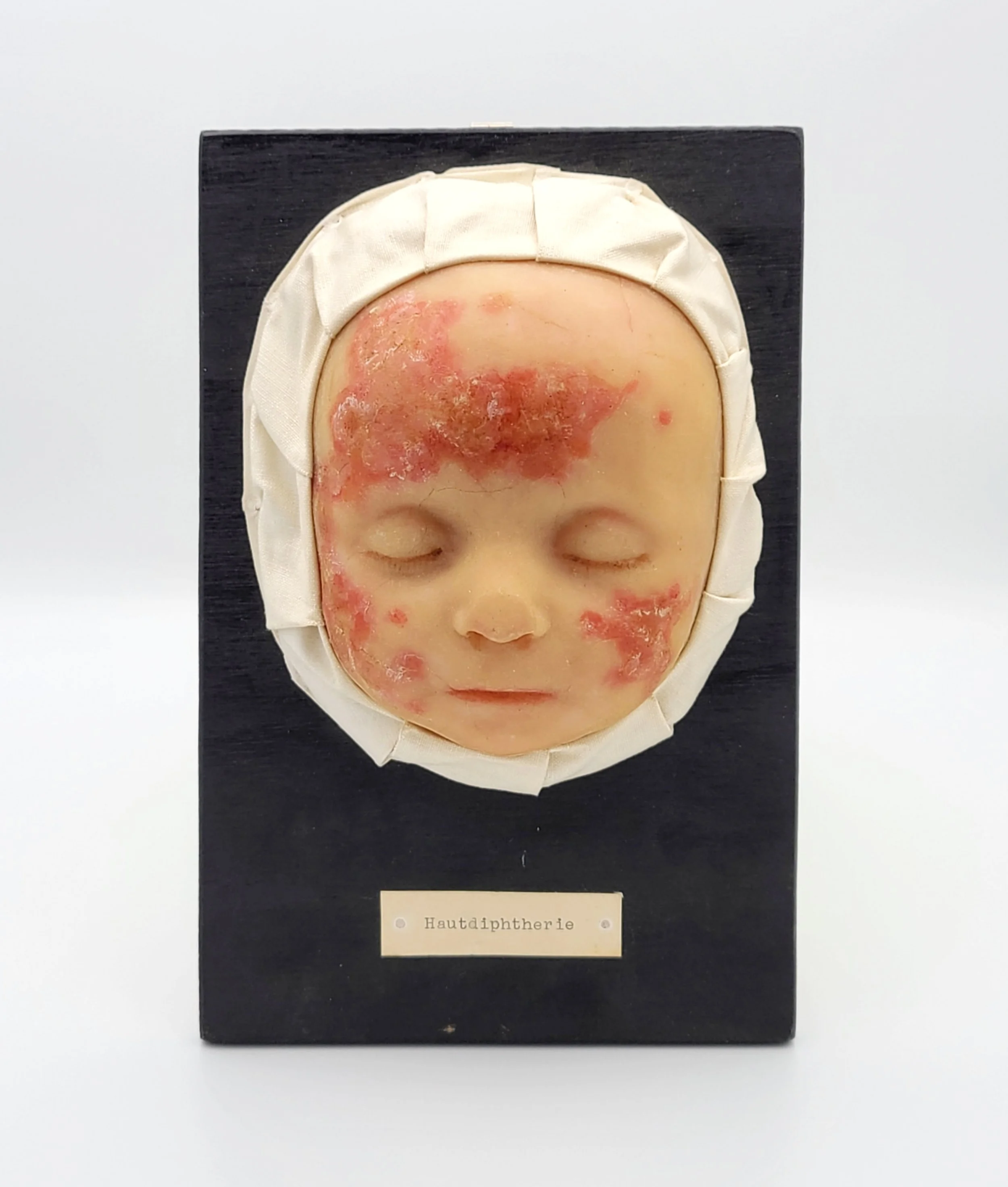 Wax moulage of a child's face showing Diphtheria