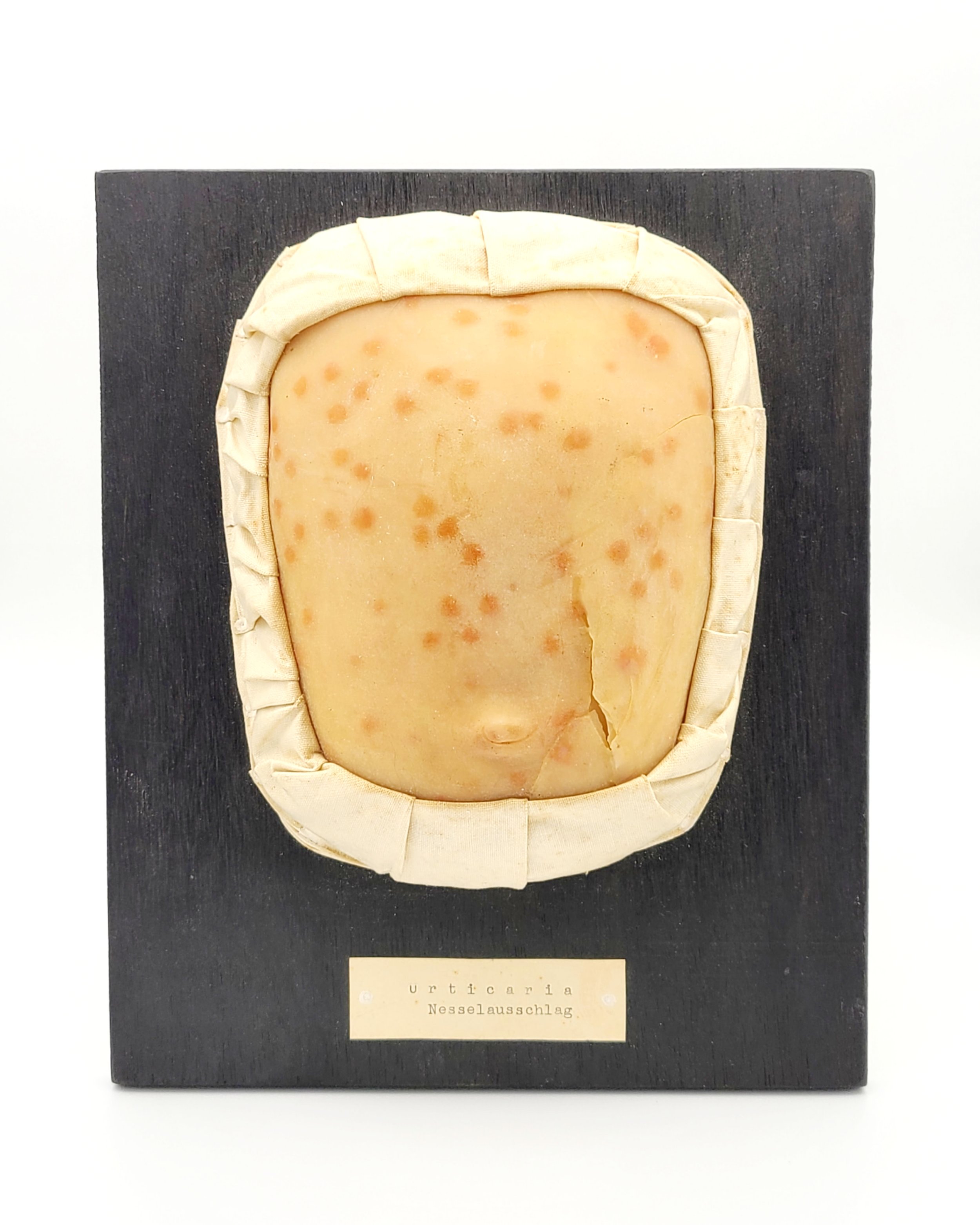 Wax moulage of a child's stomach showing Hives