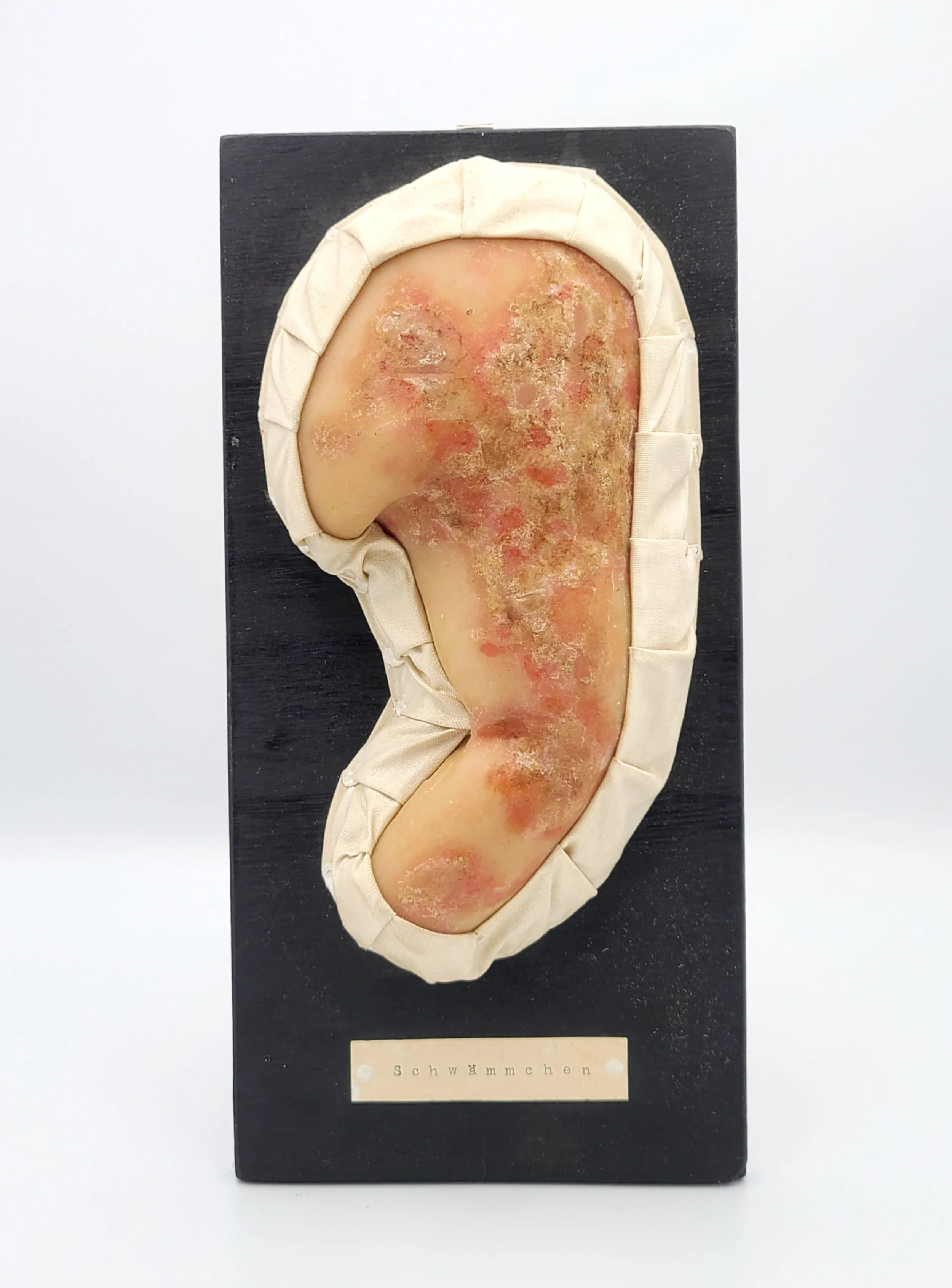 Wax moulage of an unidentified body part showing Thrush
