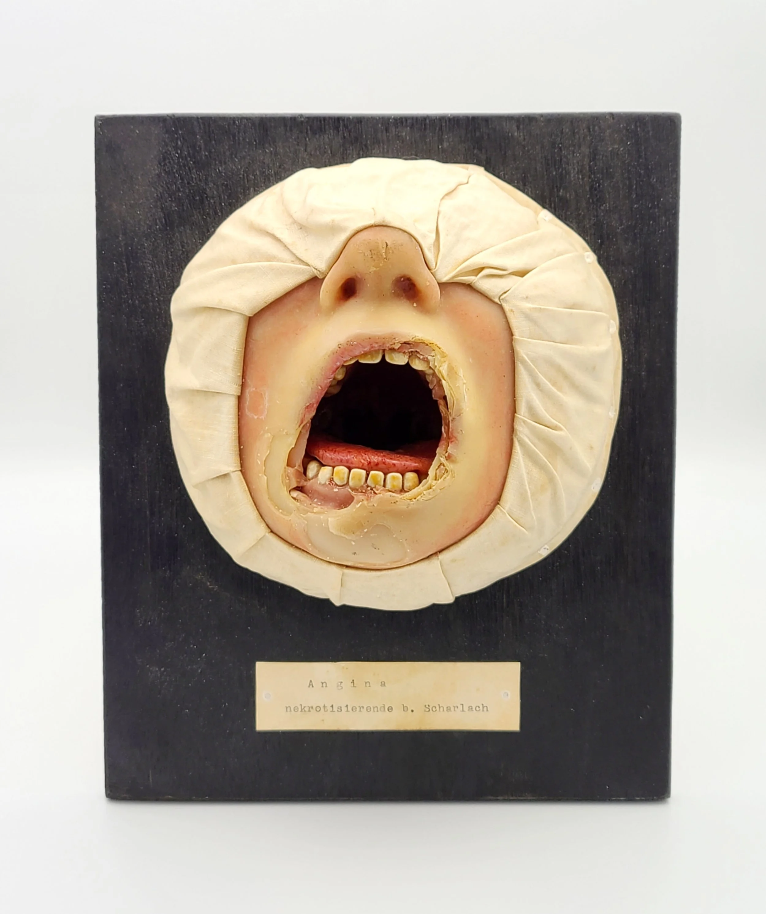 Wax moulage of adult face showing Scarlet Fever